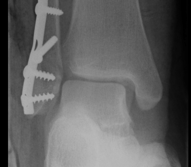 Ankle Fracture Increased Medial Clear Space
